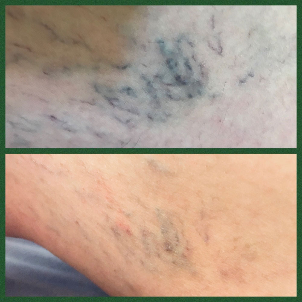 Sclerotherapy Southend-on-Sea