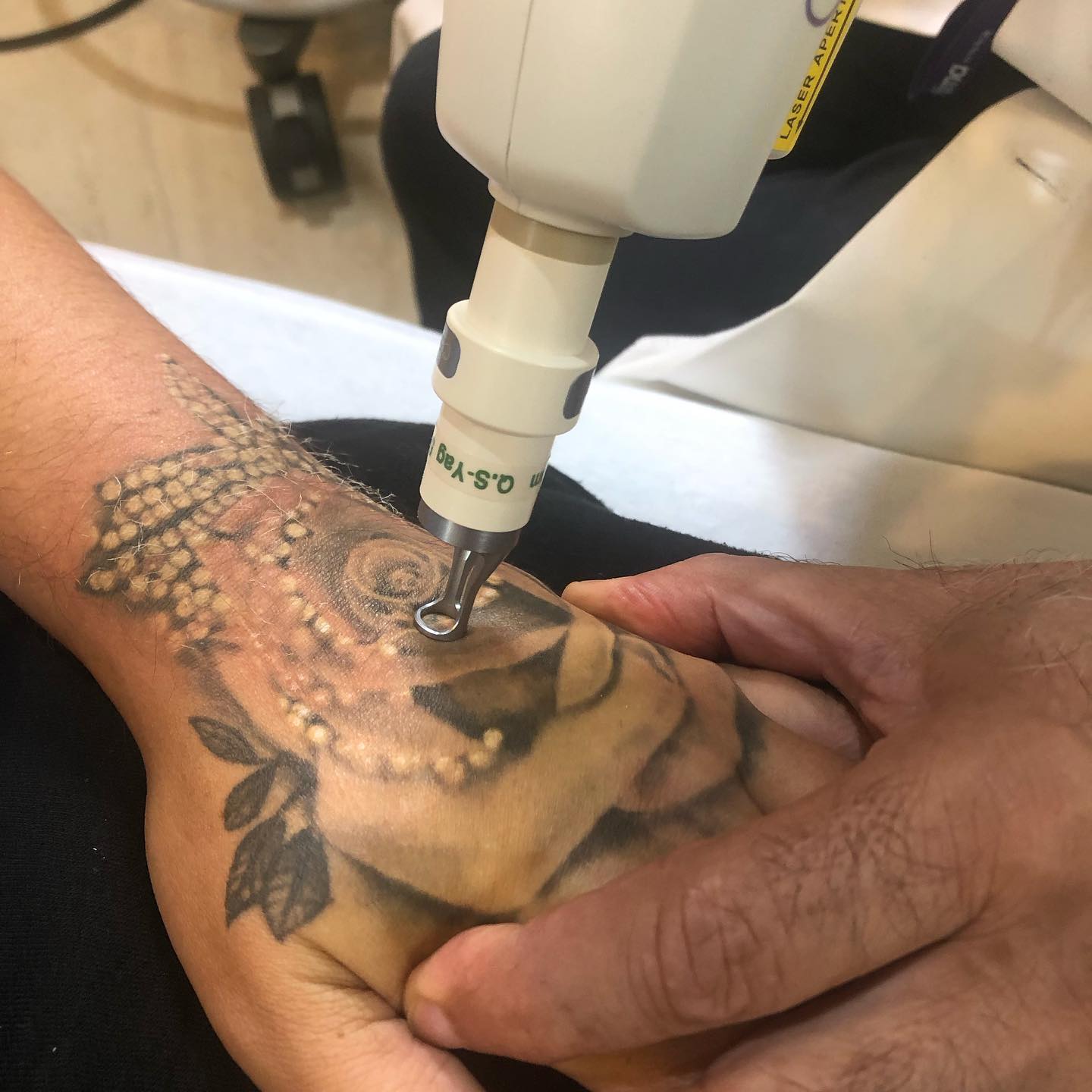 Picosure Laser Tattoo Removal | Collins Cosmetic Clinic