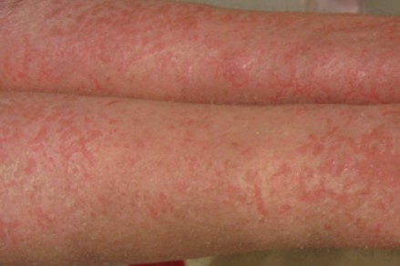 eczema dermatitis