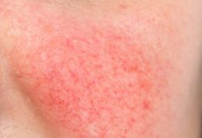 rosacea