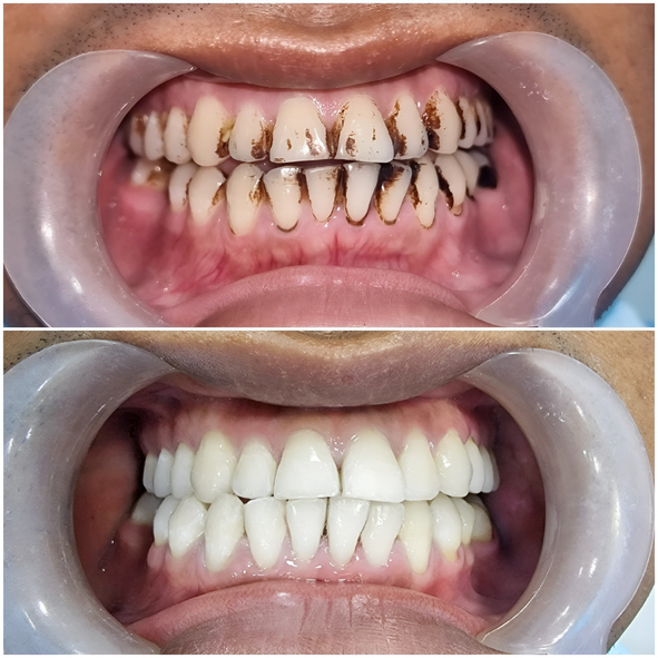 Before and after scaling and polishing treatment for tobacco stains on the teeth