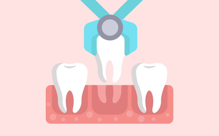 tooth extraction