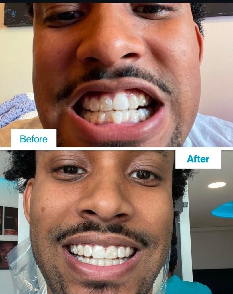 invisalign before and after