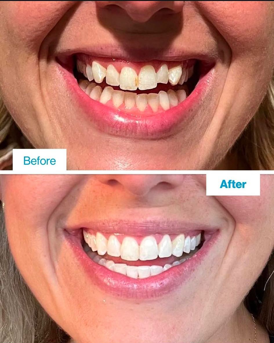 invisalign before and after